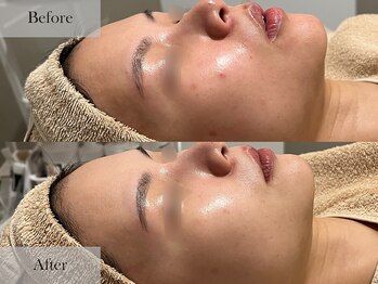 シェリーミル(Cherie Miru)/赤み/ニキビ/毛穴/色むら/くすみ