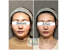 キュープ 北千住店(Qpu)/小顔頭蓋骨矯正.6