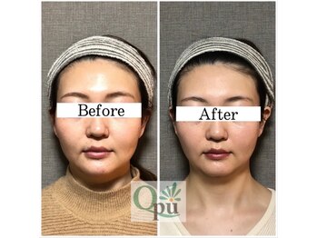 キュープ 北千住店(Qpu)/小顔頭蓋骨矯正.6