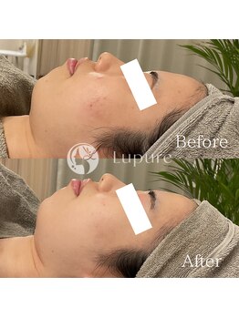 ルプレ(Lupure)/ハーブピーリング6回目