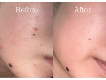 リネ(Rine)/アクネ菌を根本からケア☆