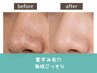 【毛穴診断付き】韓国式毛穴洗浄×毛穴徹底引き締め！¥4,000