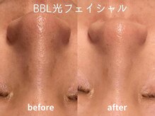 ラブ美長寿 沖縄本店(Lab)/ビフォーアフター光フェイシャル