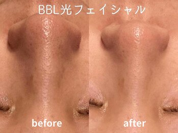 ラブ美長寿 沖縄本店(Lab)/ビフォーアフター光フェイシャル