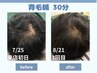 【太く強く抜けにくく】ルート育毛促進鍼 30分 10,000円→6,000円