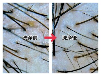 スーパースカルプ 大津店(SuperScalp)/頭皮洗浄before/after