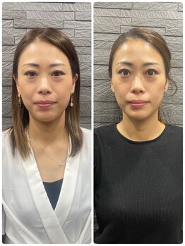 長寿鍼灸院 長寿整骨院/美容鍼50本の効果★小顔効果