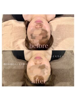 ライム 松本(LIME)/《Hi-UP*フェイスライン改造》