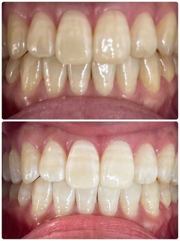 エクシアホワイトニング 札幌中島公園店/Before After［ホワイトニング］