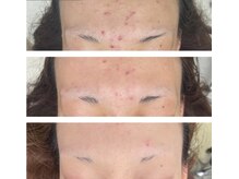 北原美顔/20代女性/ニキビ改善