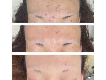 北原美顔/20代女性/ニキビ改善