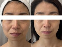 シェリー(cherie)/【NEW】リヴァイブ・スキン