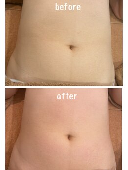 ラディアント(Radiant)/インディバ×レモンボトル