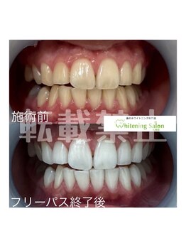 ホワイトニングサロン 札幌店/【ホワイトニング】#札幌#大通り