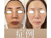 リノージュ(Linoju)の雰囲気（エクソソームでお肌のお悩み解消！幹細胞導入で美肌管理）