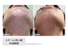 フィルムス(FILMS.)/ヒゲ脱毛のBeforeAfter