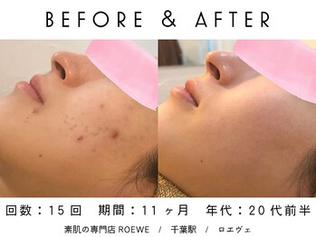 ロエヴェ(ROEWE)/ニキビ改善・毛穴ケア・肌質改善