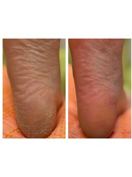 角質ケアができるサロン