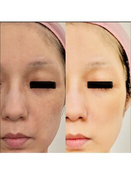 ドール(doll)/集中美白！透明感小顔ゆで卵肌に