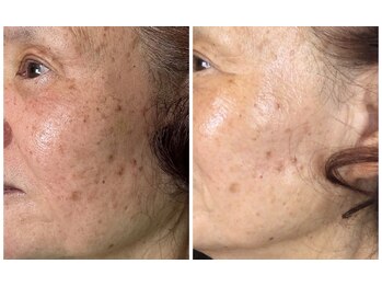 ベル(Belle)/70代のお客様 Before After