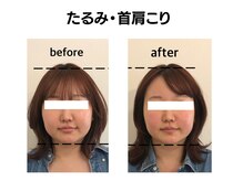 シン(SHINE)/美容鍼灸プレミアム