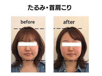 シン(SHINE)/美容鍼灸プレミアム