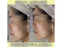 ハニエル(Haniel)/カーボキシー症例