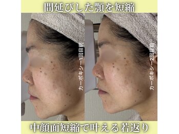 ハニエル(Haniel)/カーボキシー症例