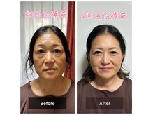 ミッツ(MITTU)の雰囲気（ルート鬼美容鍼でコリがとれ本来の自分へと！＃ルート鍼）