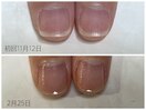 自爪育成３ヵ月コース