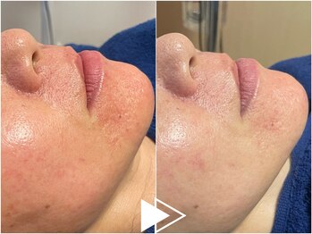 リシェス(Richesse)/赤み毛穴改善★初回¥9990