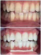 エクシアホワイトニング 札幌中島公園店/Before After［ホワイトニング］