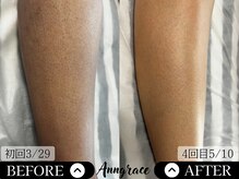 アングレイス(Anngrace)/【全身脱毛あし】Before/After
