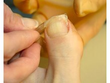 きりん接骨鍼灸院 尼崎武庫之荘店/巻き爪矯正～プレート装着
