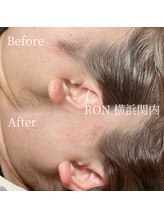 サロンロン 横浜関内(SALON RON)/もみあげ脱毛/美容電気脱毛
