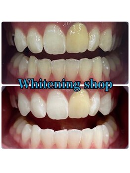 ホワイトニングショップ 武蔵小杉店/【BeforeAfter】2回 施術後比較