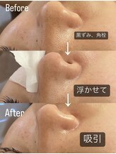 ラナ(Lana)/3D毛穴洗浄