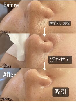 ラナ(Lana)/3D毛穴洗浄