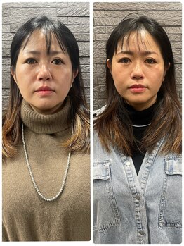 長寿鍼灸院 長寿整骨院/ハリネズミ女優美容鍼効果★