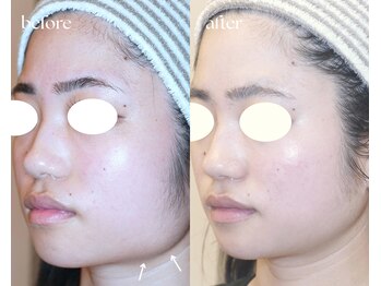 岩川治療院/エラの強張り、肌改善