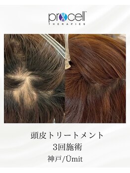 ユミト(Umit)/プロセルスカルプ