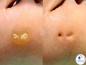 プラスワンフット 本厚木(+1 Foot)/タコ・魚の目ケア！痛みから解放