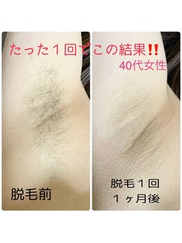 モモハダ(momo hada)/脇脱毛