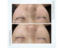 シャルムパリス(charme paris)/小鼻つるん◎１回の施術変化