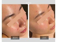サロントット(salon totto)/before→after　ニキビケア