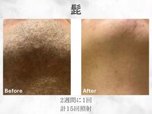 ベル(Belle)/メンズヒゲ脱毛