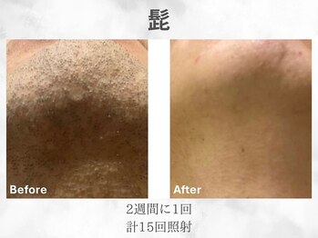 ベル(Belle)/メンズヒゲ脱毛