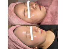 ヴィーナス(Venus)/白玉スキンフェイシャル