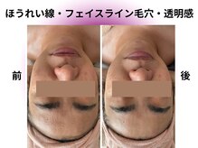 カリアンヌ/透明感/リフトアップ/小顔