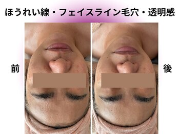 カリアンヌ/透明感/リフトアップ/小顔